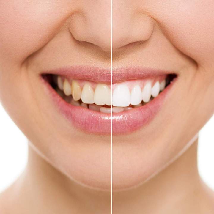 Brighten your teeth for a radiant, confident smile.