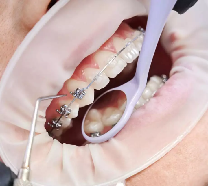 LF Orthodontics is an approach that focuses on teeth and bone alignment to improve bite and muscle function.